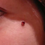 Un piercing en implant