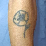 Recouvrement d'un tatouage